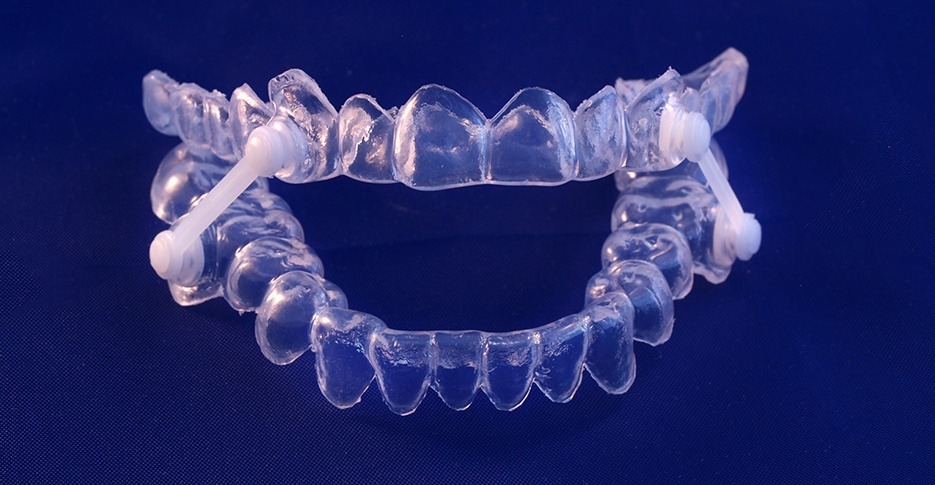 Closeup of custom Herbst oral appliance