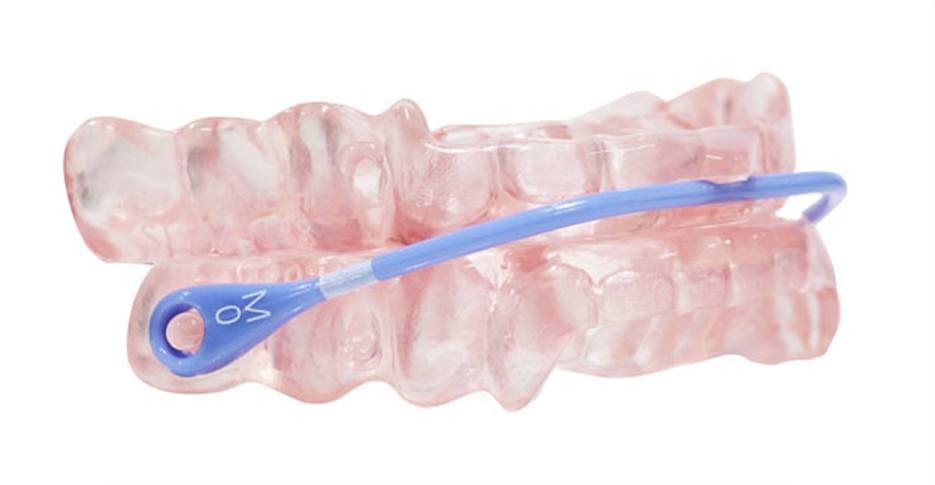 Closeup of somnodent avant sleep apnea oral appliance