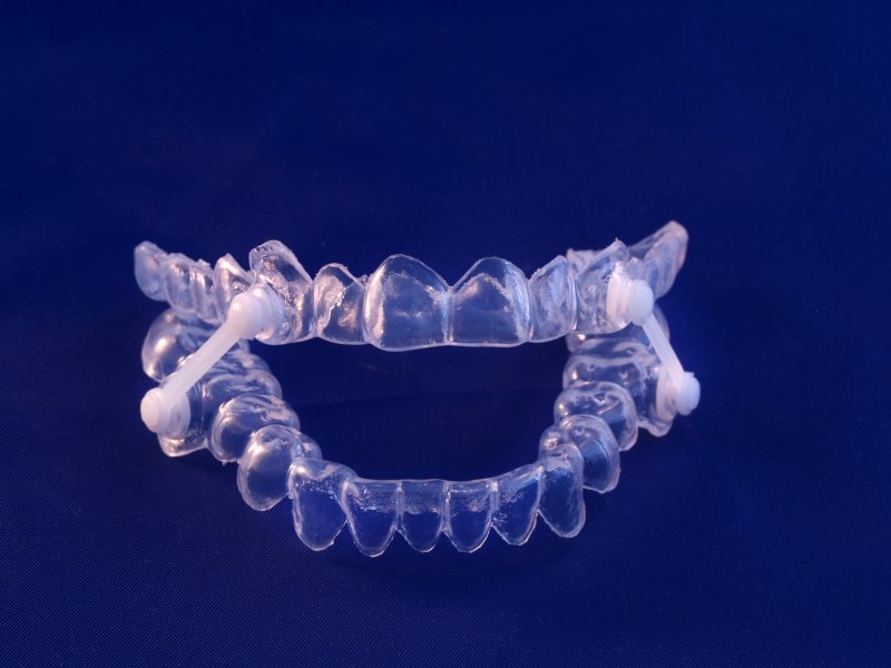 Oral appliance for sleep apnea on a blue background