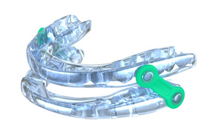 Close-up of an oral appliance for sleep apnea